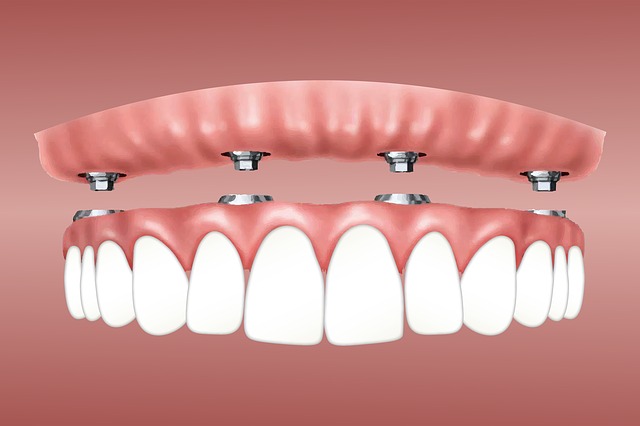 4. How Retainers Help Maintain Your Smile's New Alignment after Wisdom Teeth Surgery